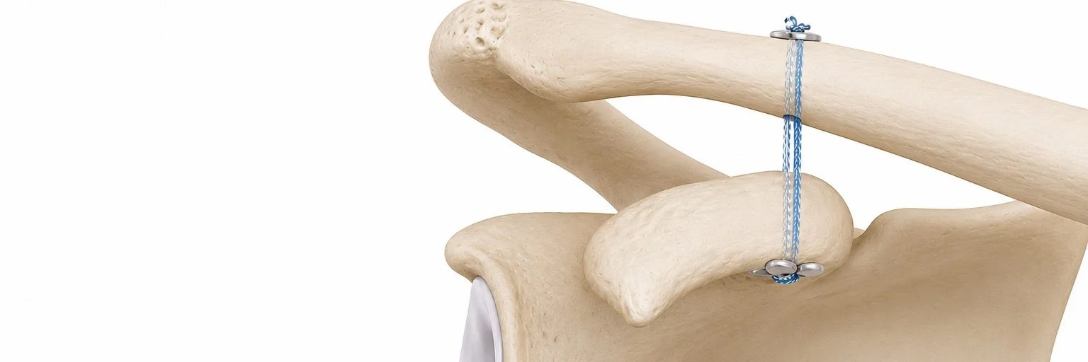 AC Joint Reconstruction