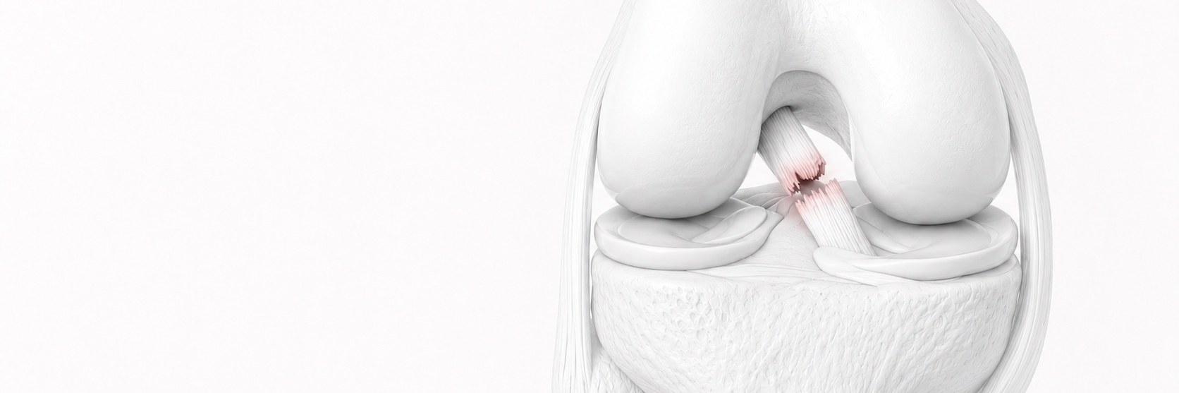 Anterior Cruciate Ligament (ACL) Tear