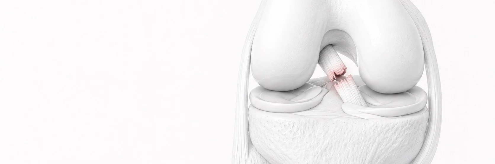 Anterior Cruciate Ligament (ACL) Tear