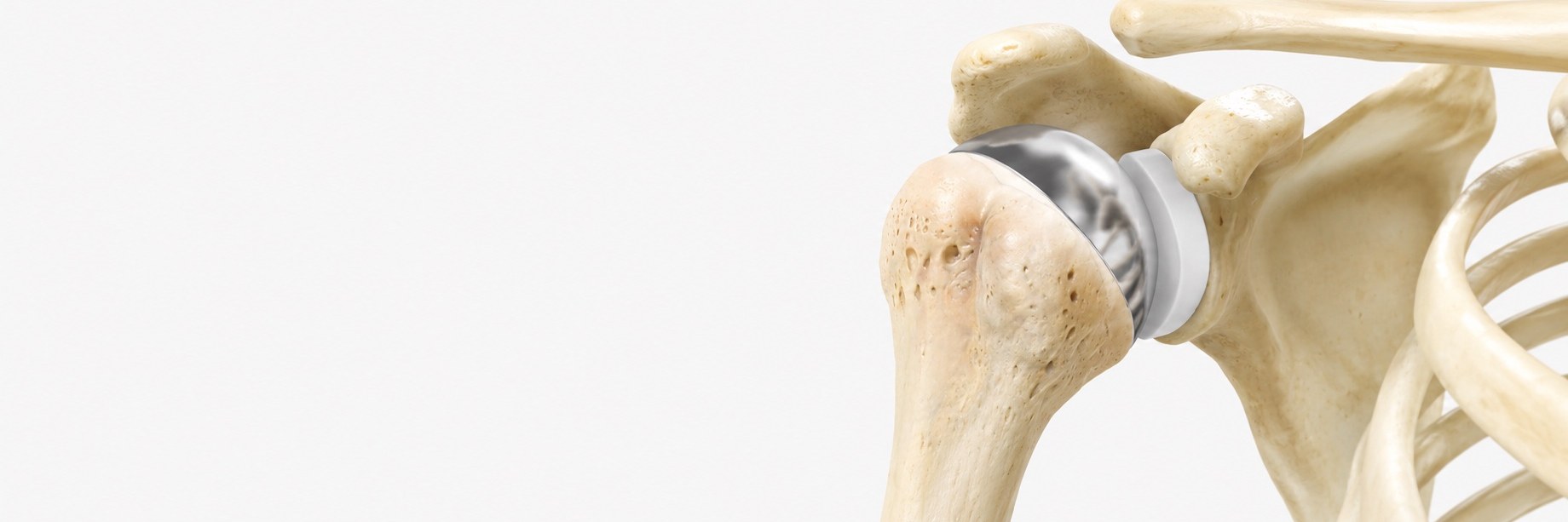 Anatomic Total Shoulder Replacement