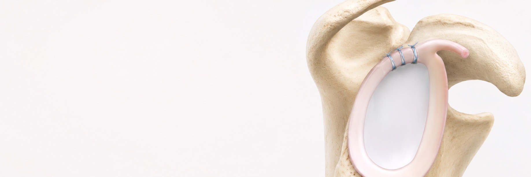 Biceps Tenodesis & SLAP Repair