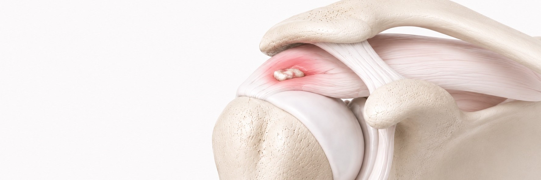 Calcific Tendonitis
