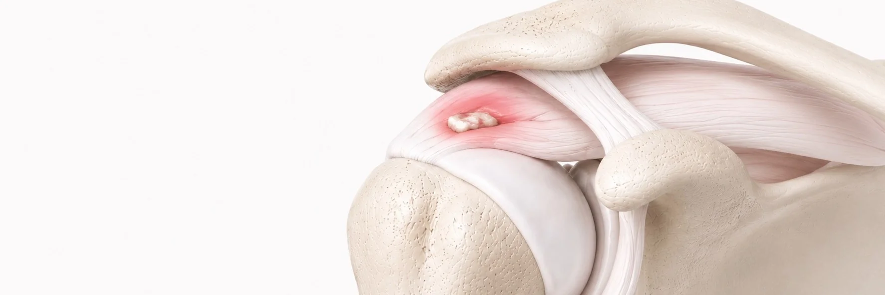 Calcific Tendonitis