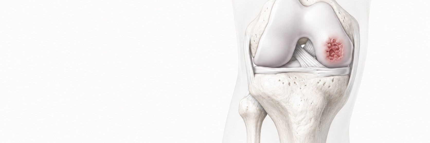 Cartilage restoration