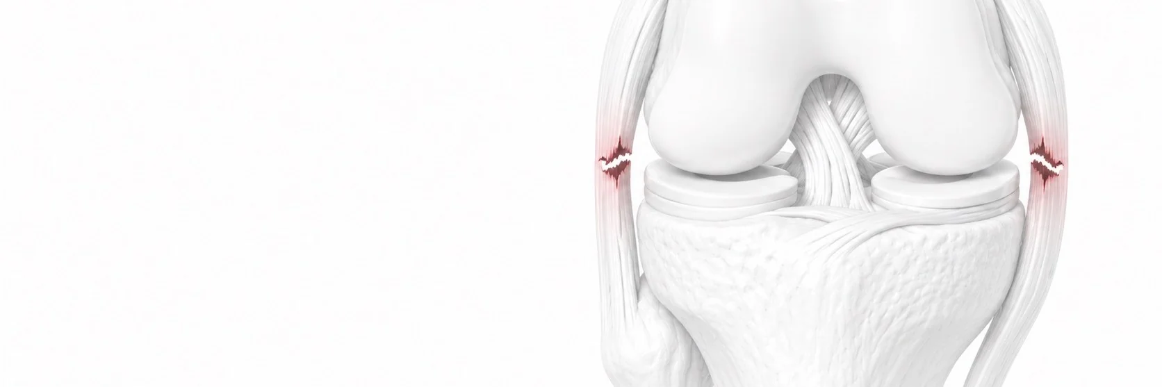 MCL Injury