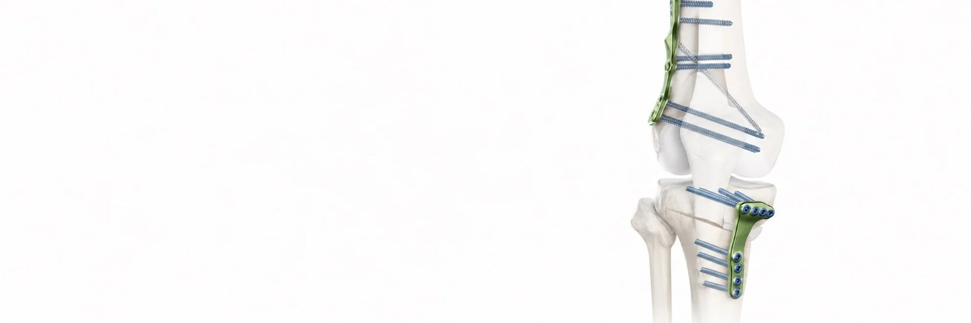 Corrective osteotomy of the knee