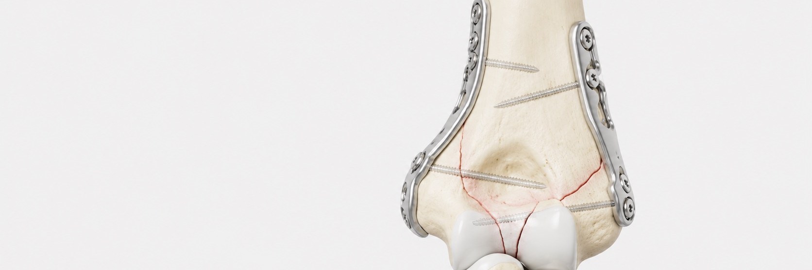 Distal Humerus Fracture Surgery