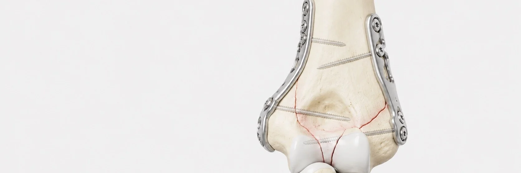Distal Humerus Fracture Surgery