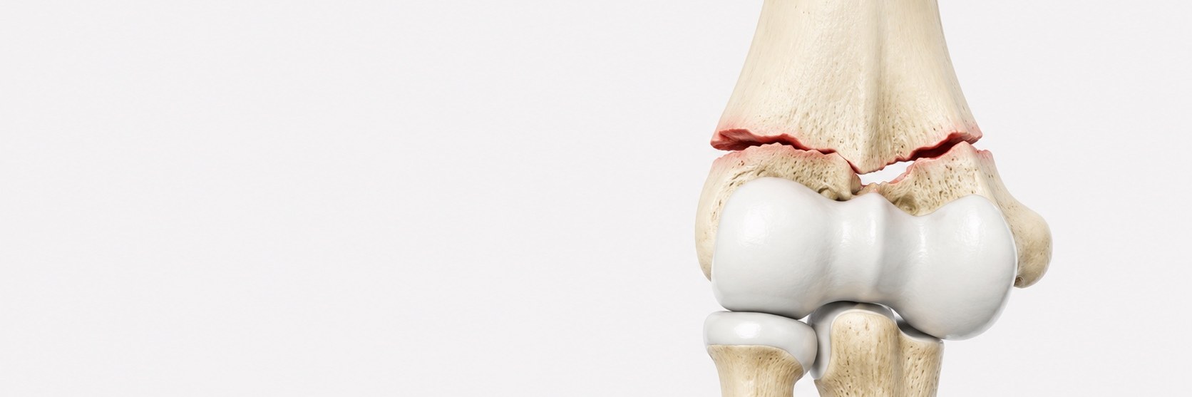 Distal Humerus Fractures