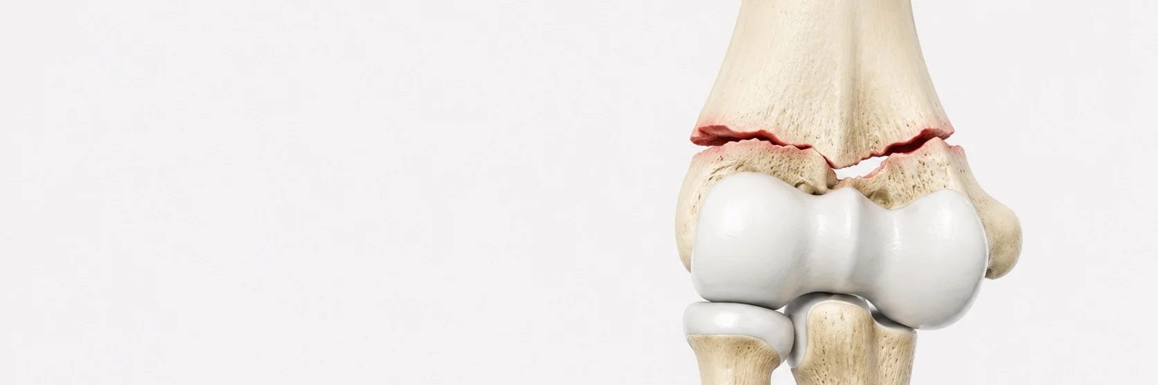 Distal Humerus Fractures