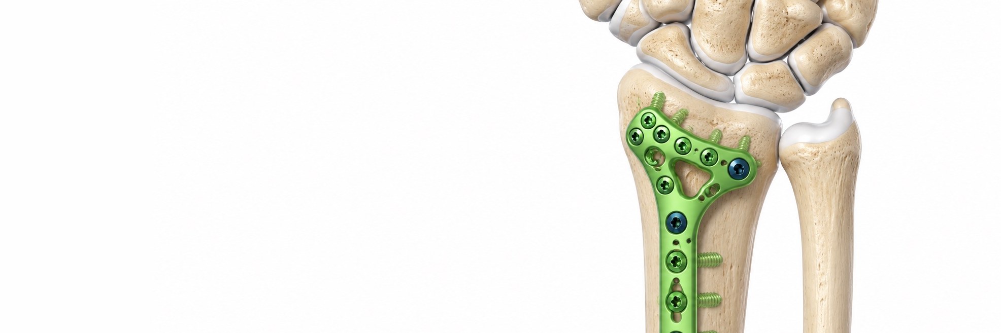 Distal Radius Fracture Fixation