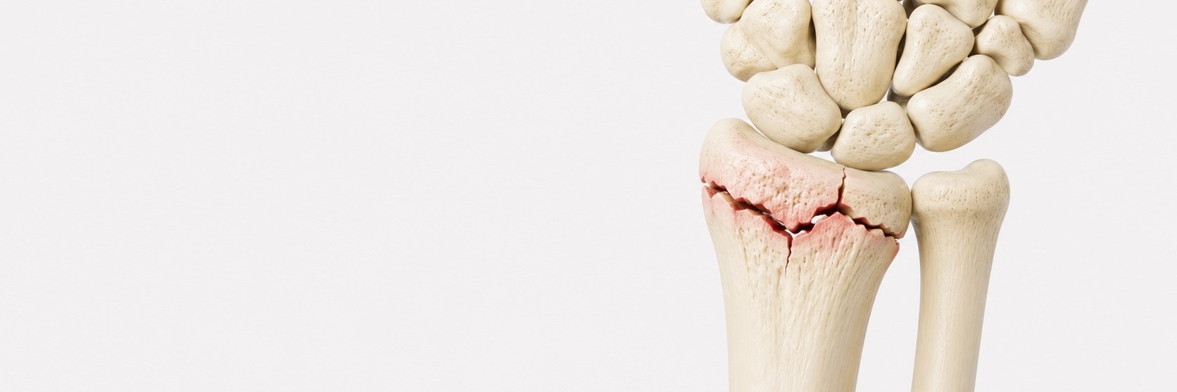 Distal Radius Fractures