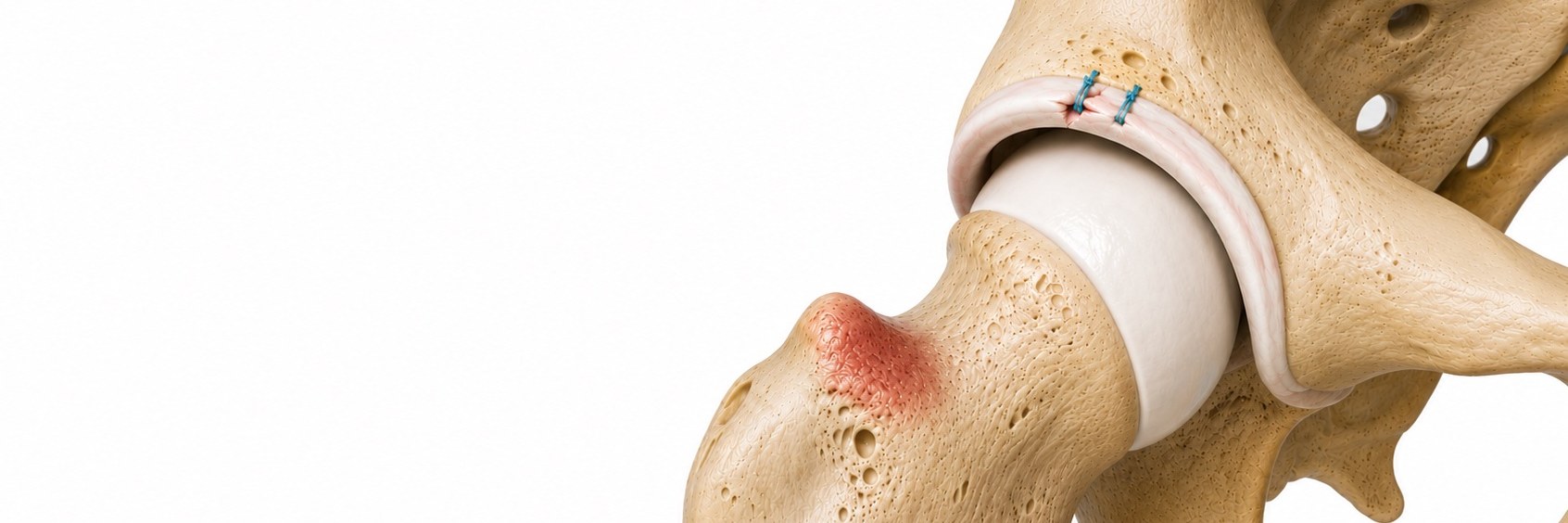 Hip Arthroscopy