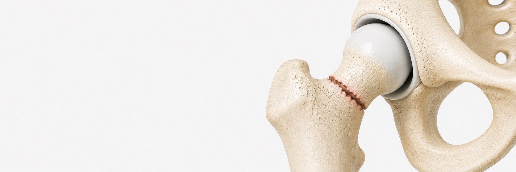 Hip Fractures
