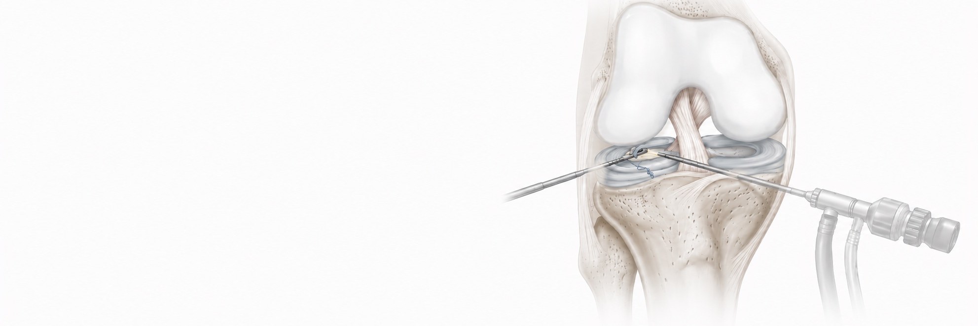 Knee arthroscopy