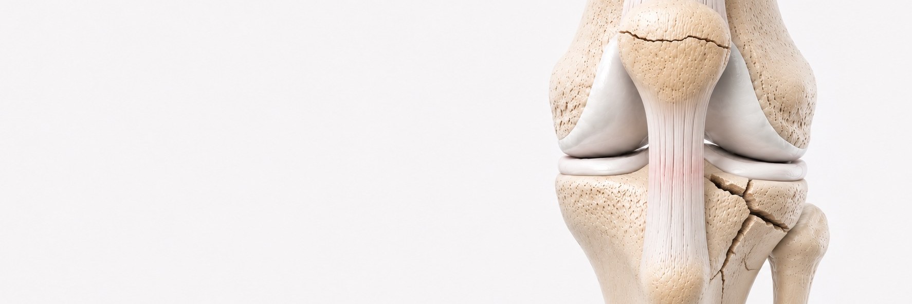 Knee Fractures