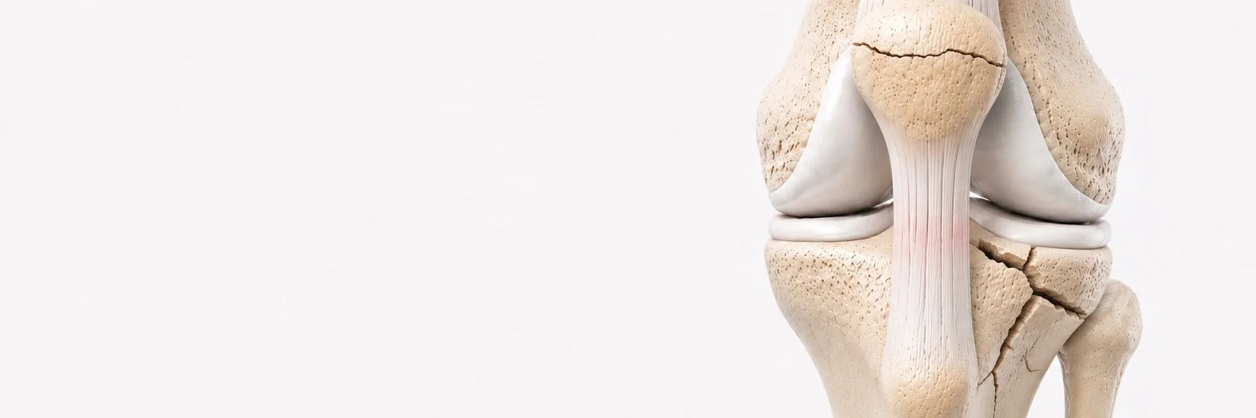 Knee Fractures