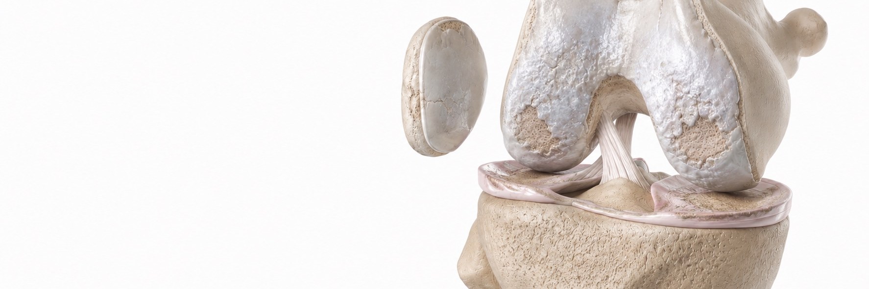 Knee Osteoarthritis
