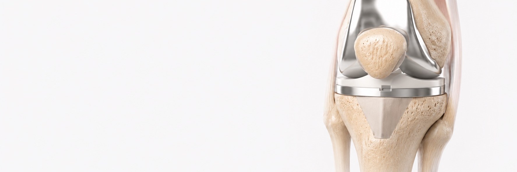 Total knee replacement