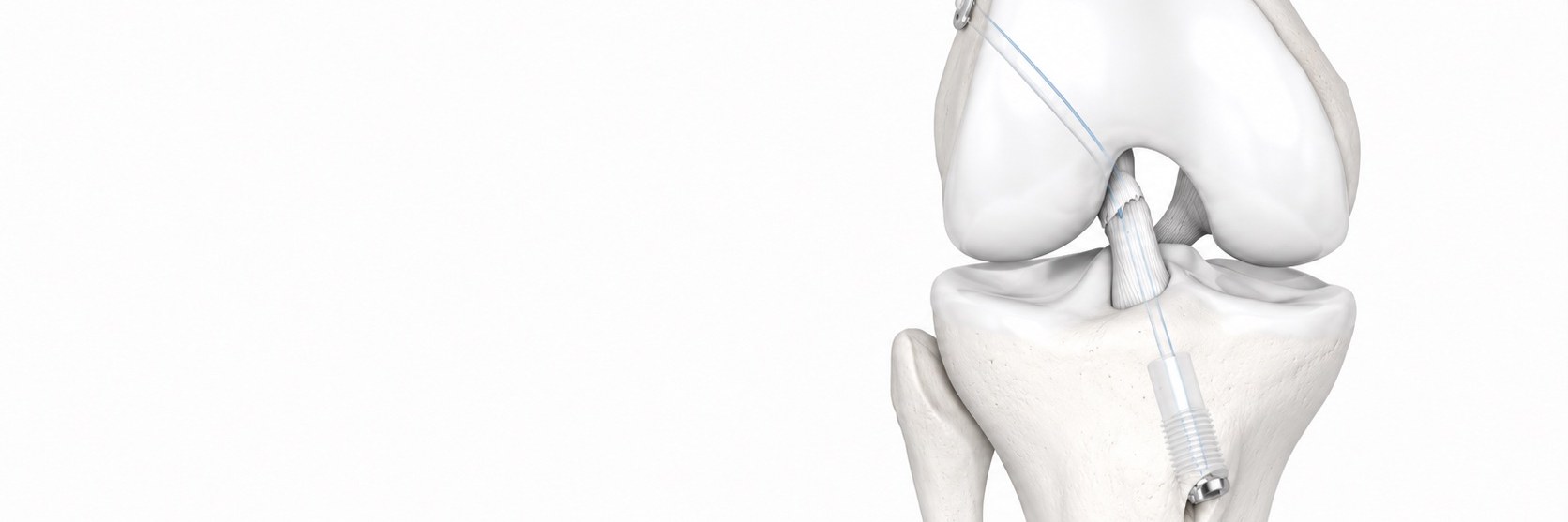ACL repair with Ligamys