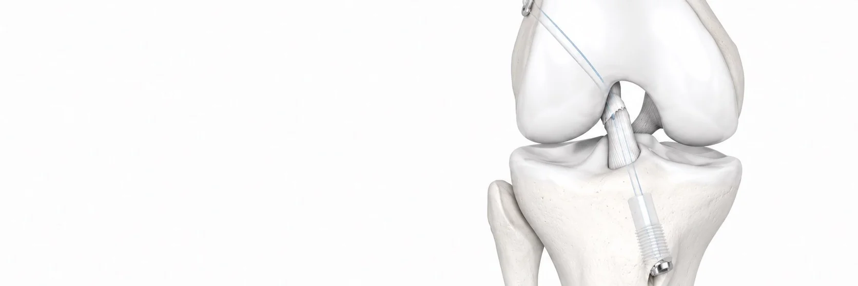ACL repair with Ligamys