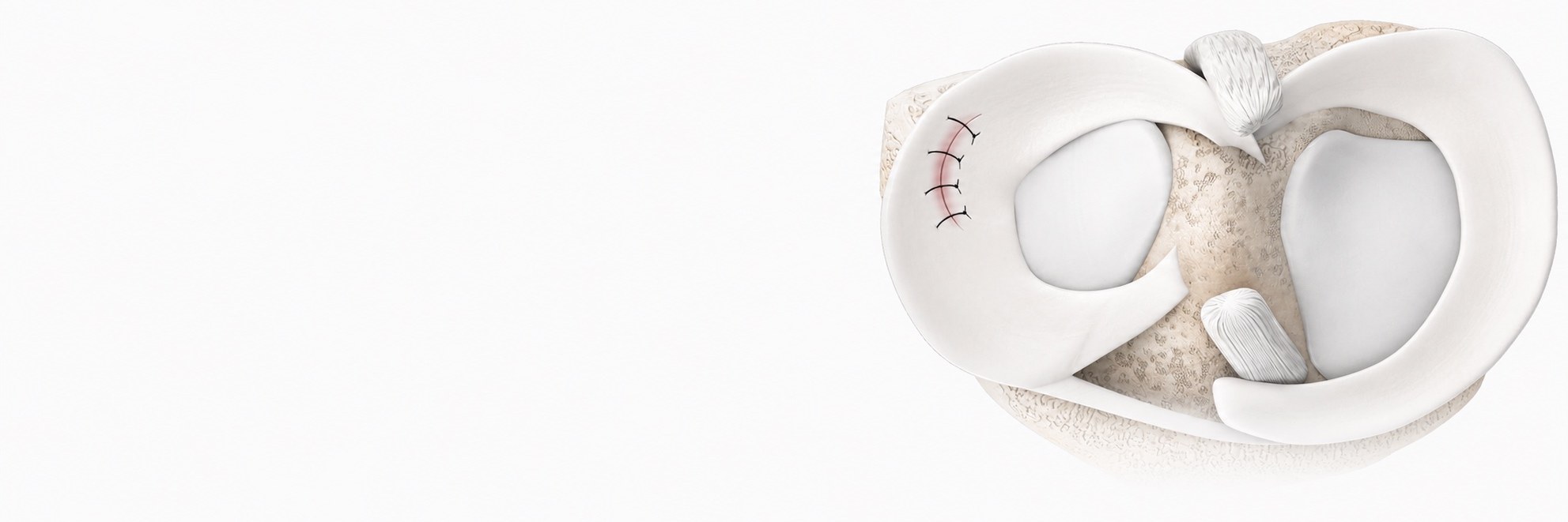 Meniscus surgery