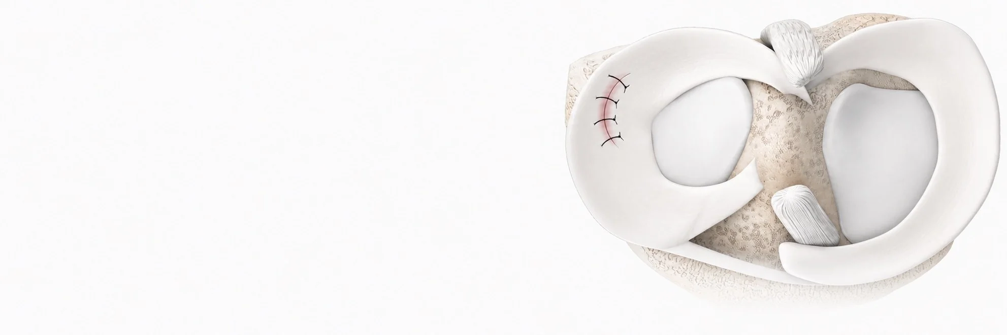 Meniscus surgery