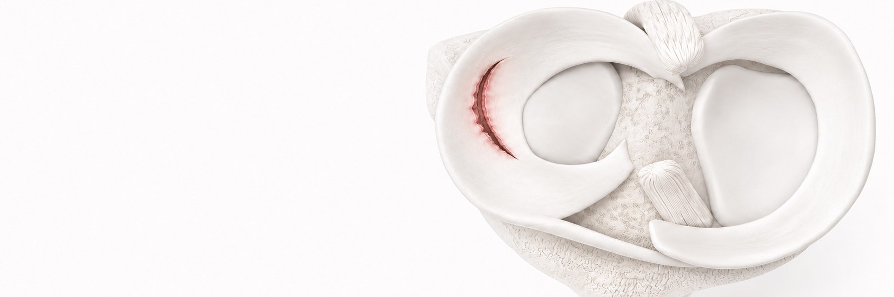 Meniscus Tear