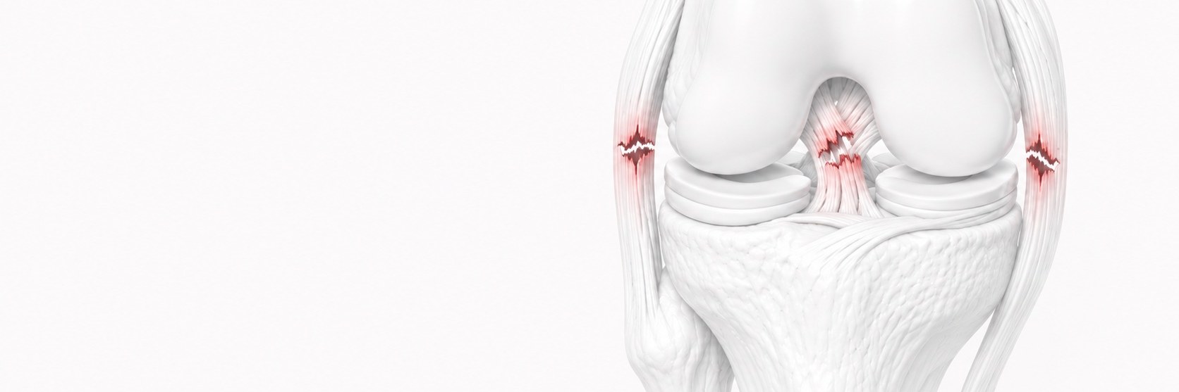 Multi-Ligament Knee Injuries