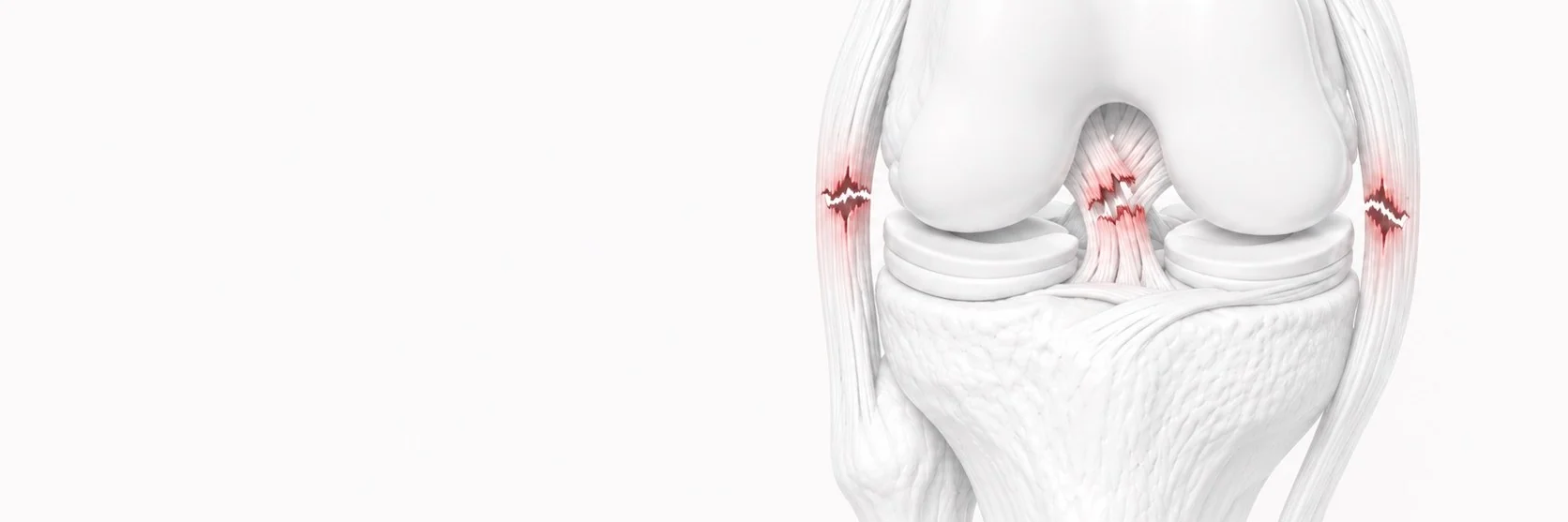 Multi-Ligament Knee Injuries