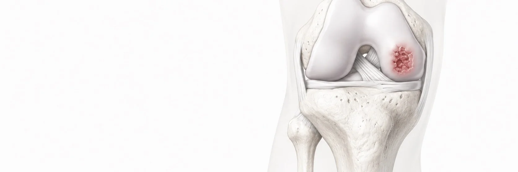 Osteochondritis Dissecans (OCD)