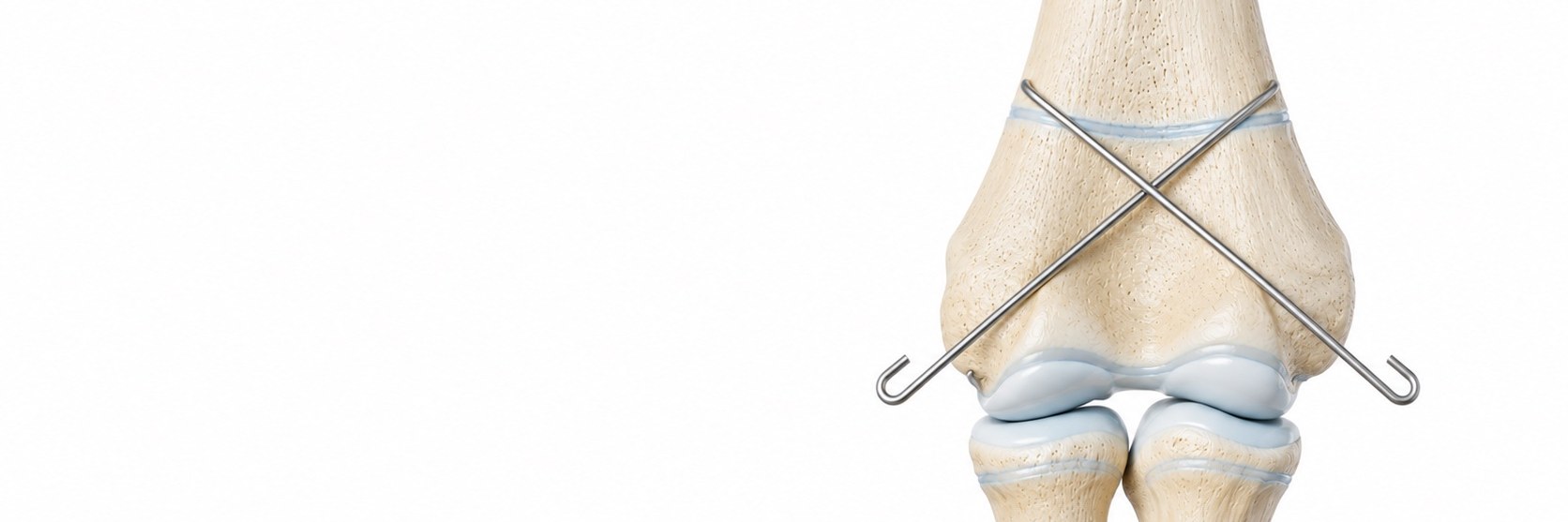 Paediatric Fracture Care
