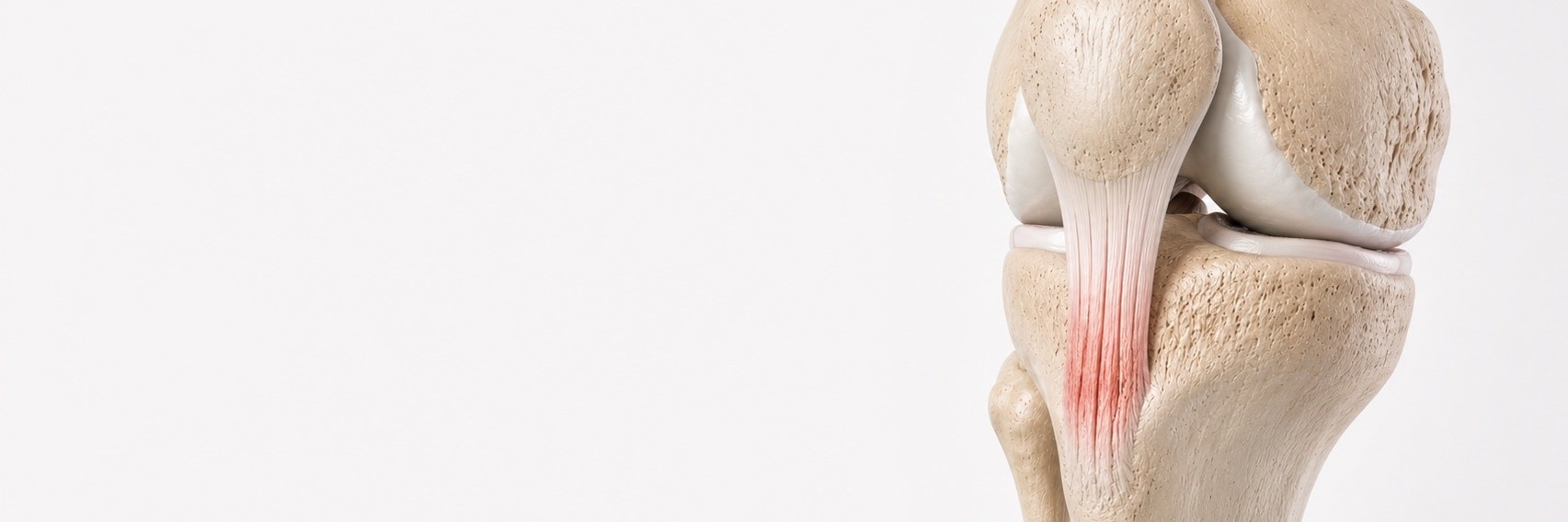 Patellar Tendinopathy (Jumper’s Knee)
