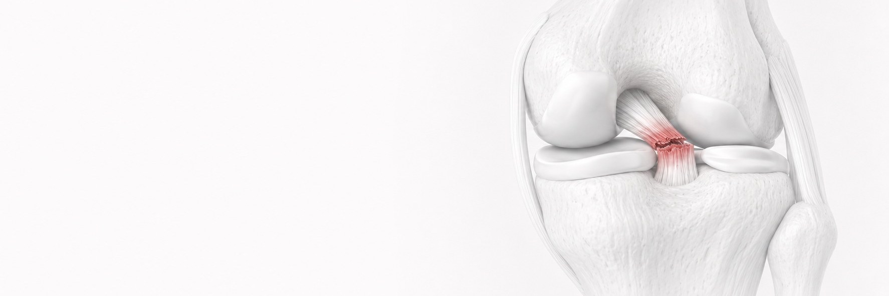 Posterior Cruciate Ligament (PCL) Injury