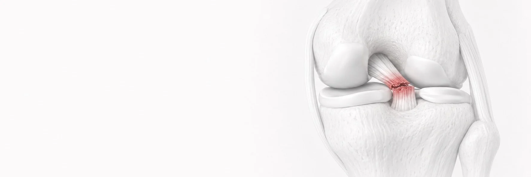 Posterior Cruciate Ligament (PCL) Injury