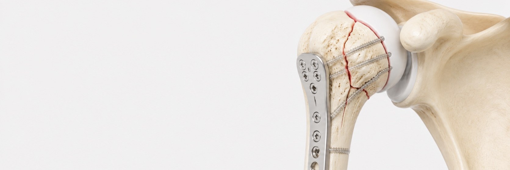 Proximal Humerus Fracture Surgery