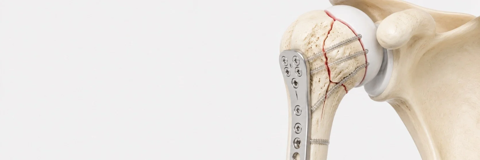 Proximal Humerus Fracture Surgery