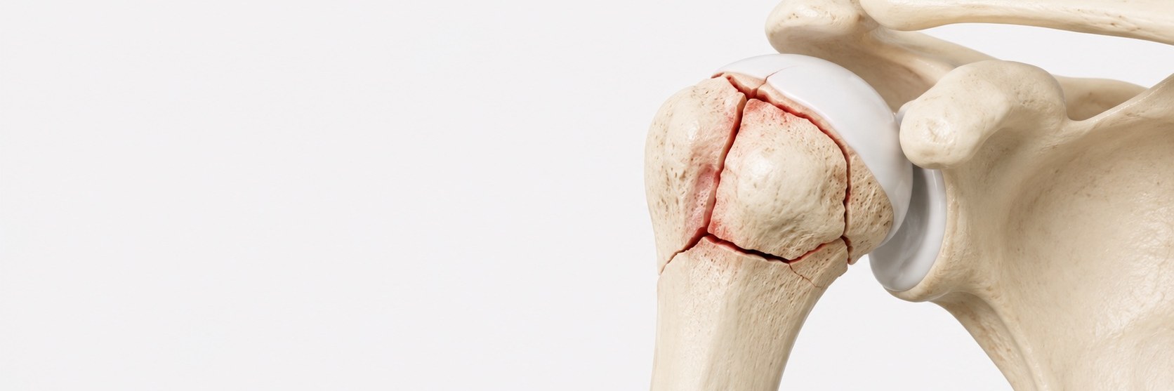 Proximal Humerus Fractures