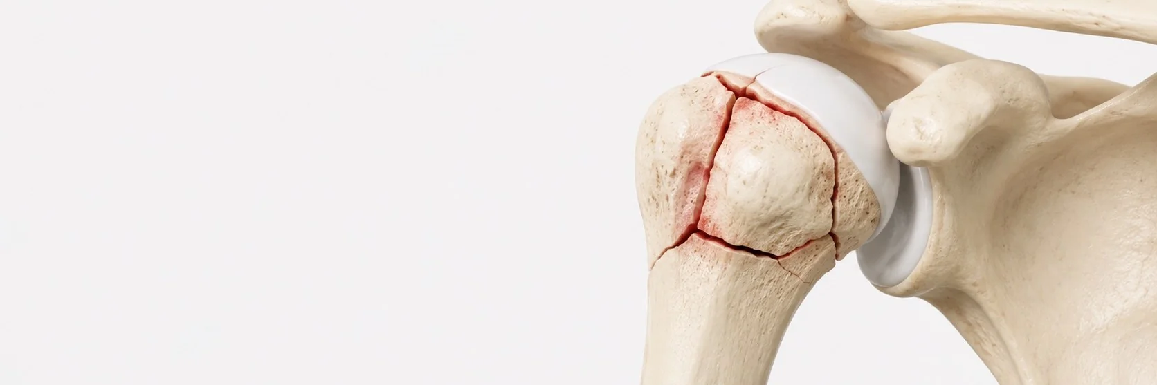 Proximal Humerus Fractures