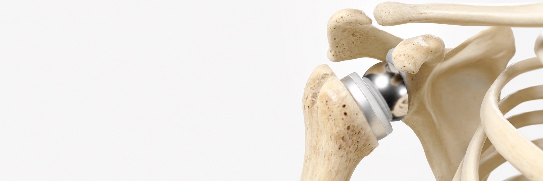 Reverse Shoulder Replacement