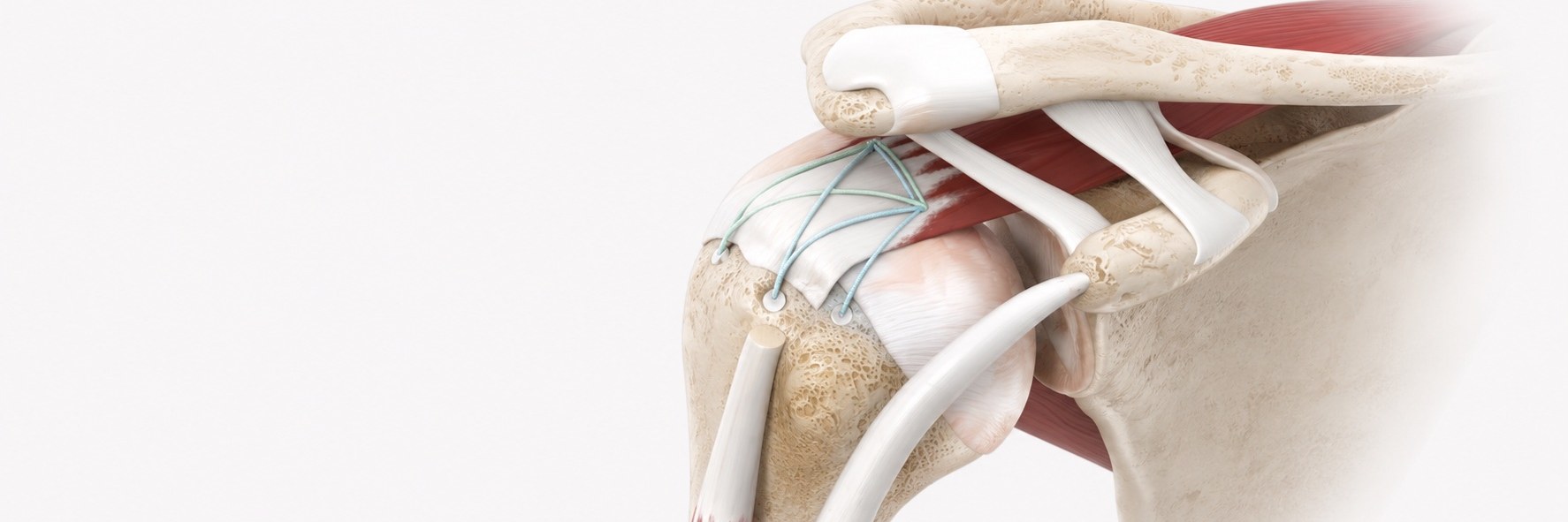 Arthroscopic Rotator Cuff Repair