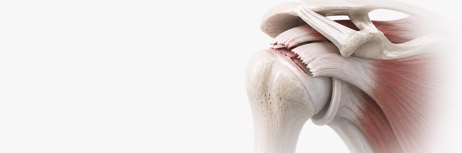 Rotator Cuff Tear