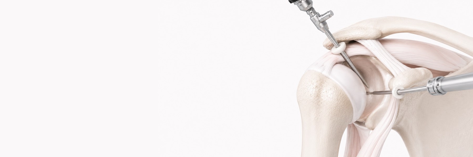 Shoulder Arthroscopy