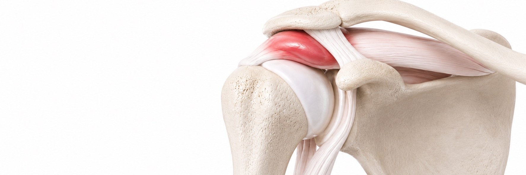 Shoulder Impingement Syndrome