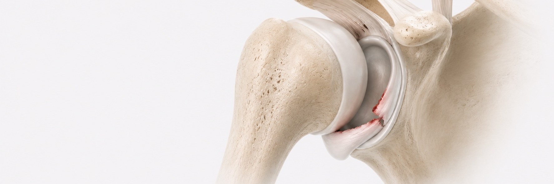 Shoulder Instability