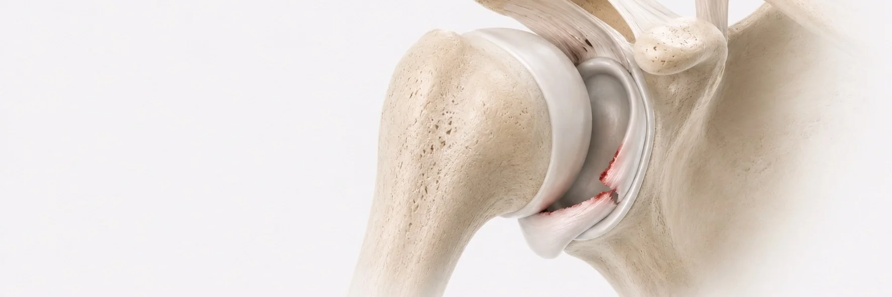 Shoulder Instability
