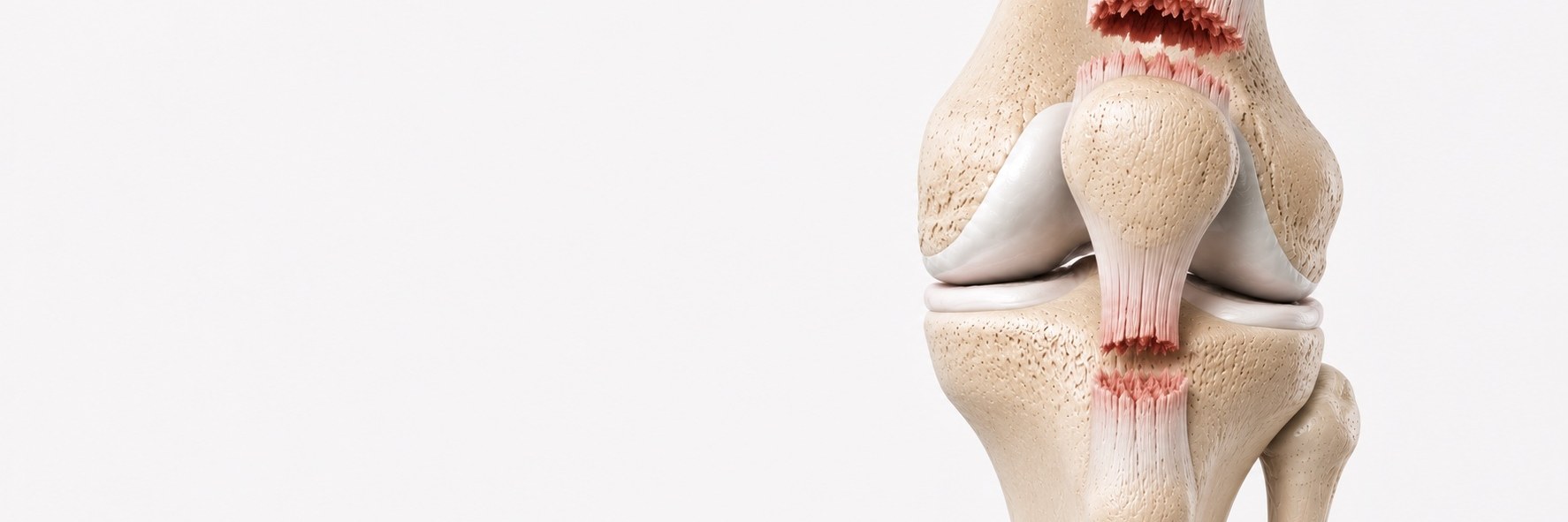 Quadriceps & Patellar Tendon Rupture
