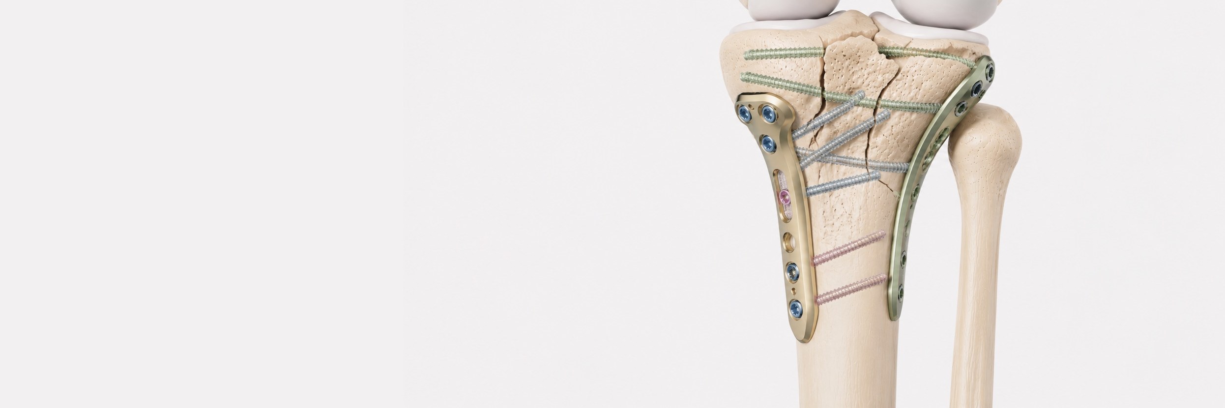 Tibial Plateau Fracture Surgery (360°)