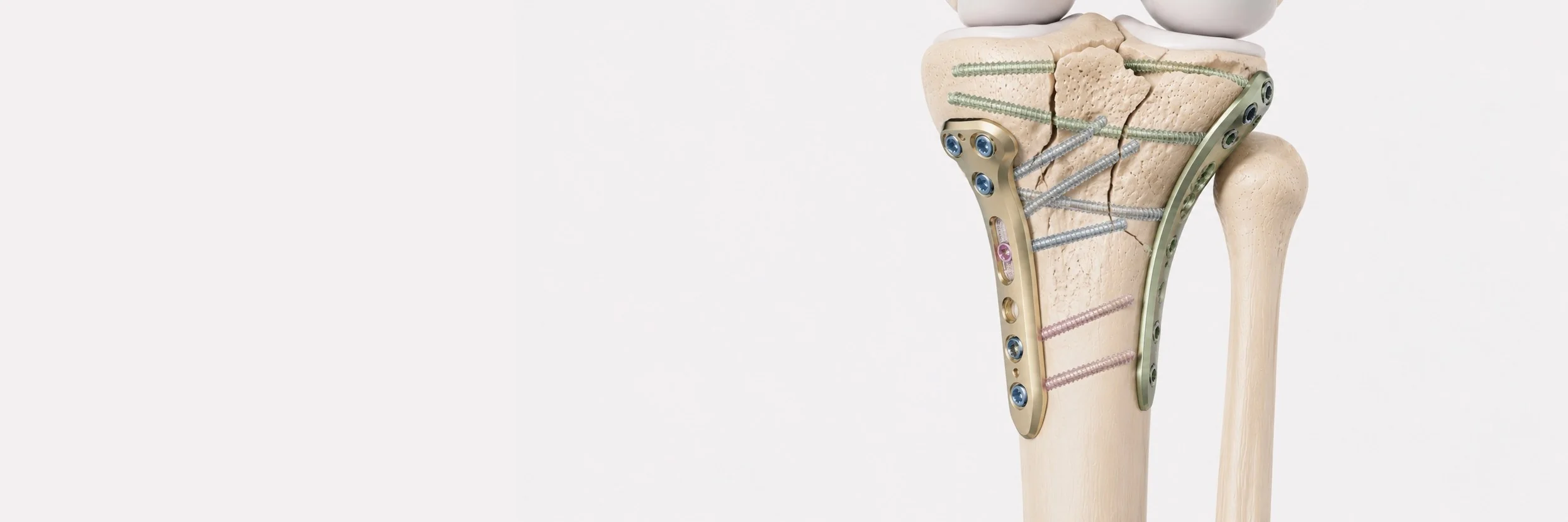 Tibial Plateau Fracture Surgery (360°)