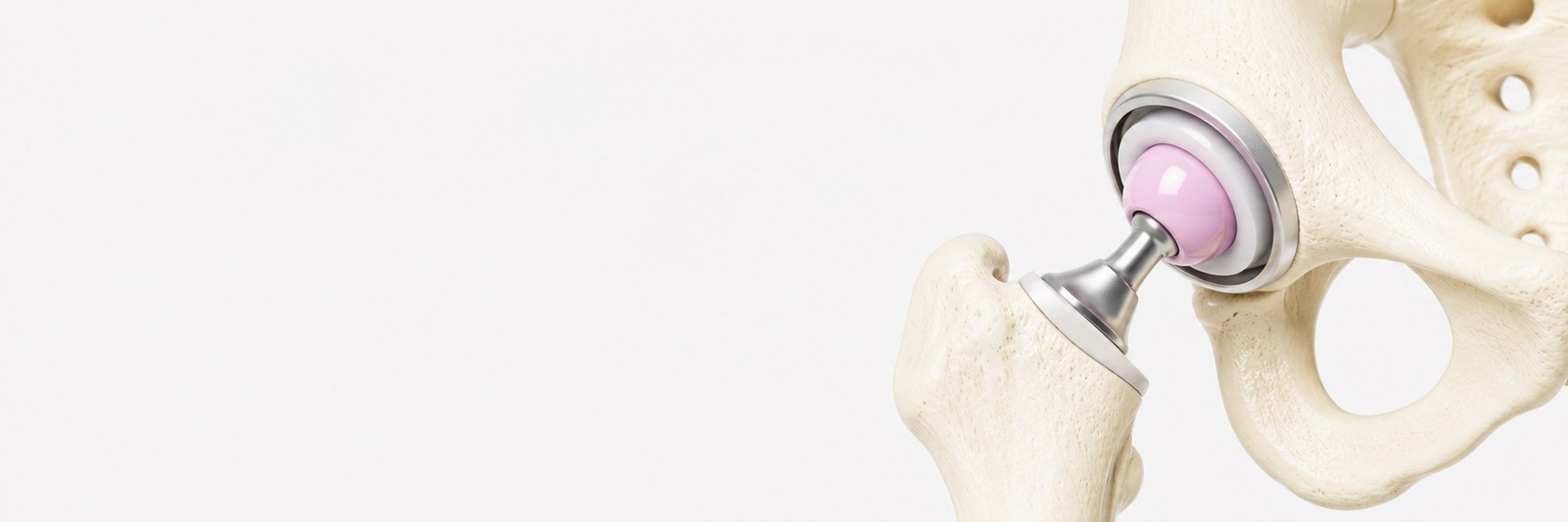 Total Hip Replacement